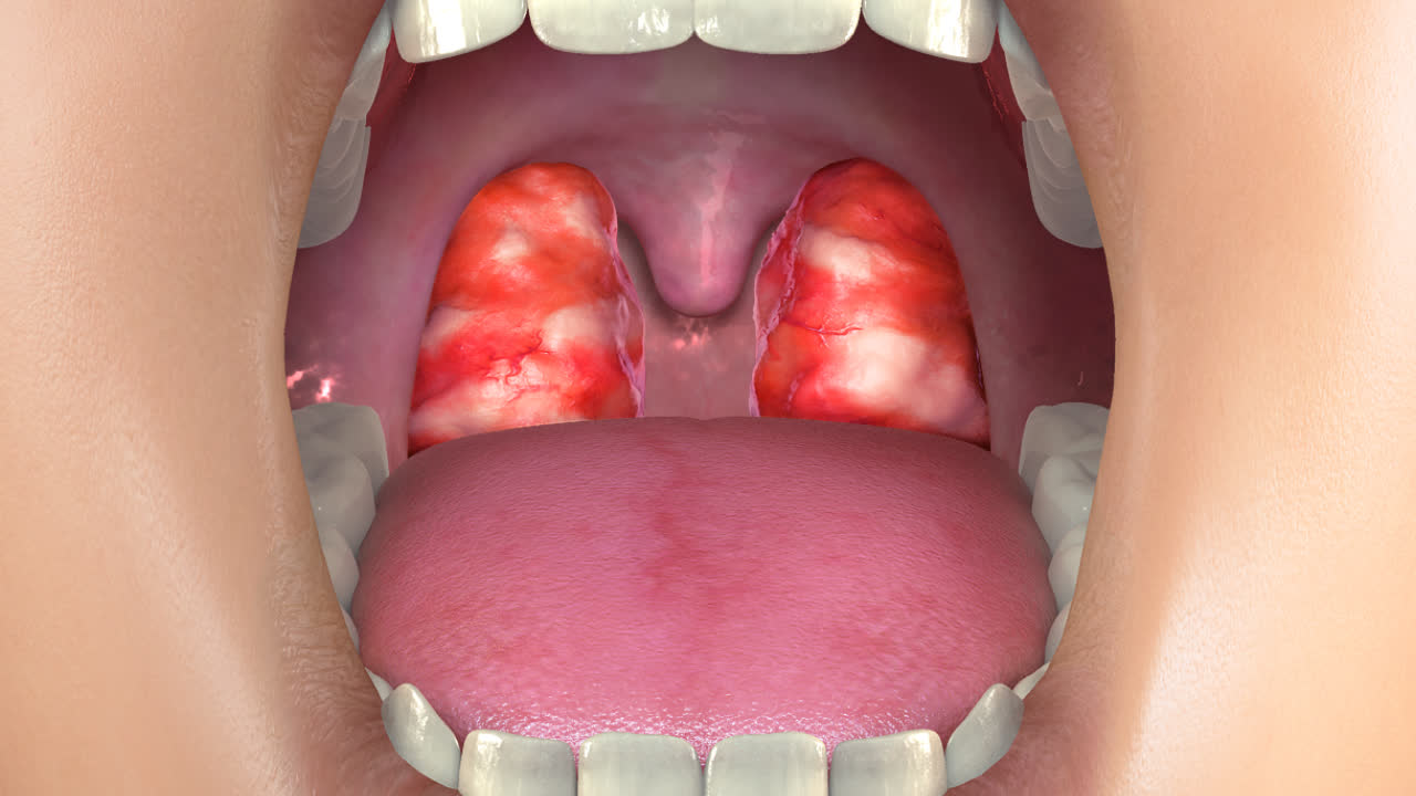 Tonsillitis Overview ENTJC