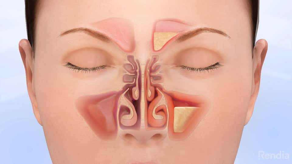 You are currently viewing Acute Sinusitis: Overview