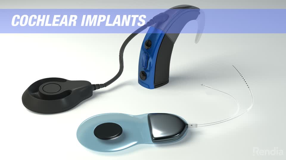 You are currently viewing Cochlear Implants: Treatment Overview