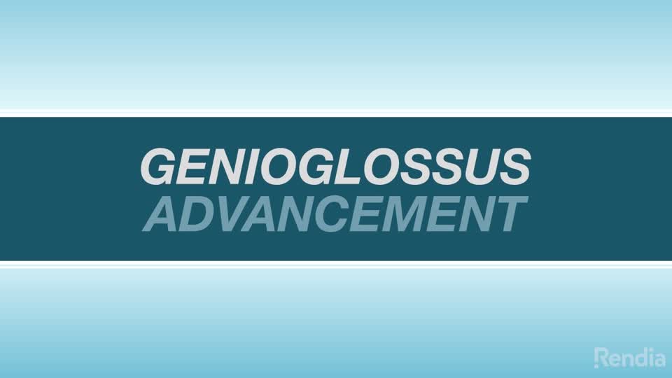 You are currently viewing Genioglossus Advancement: Overview