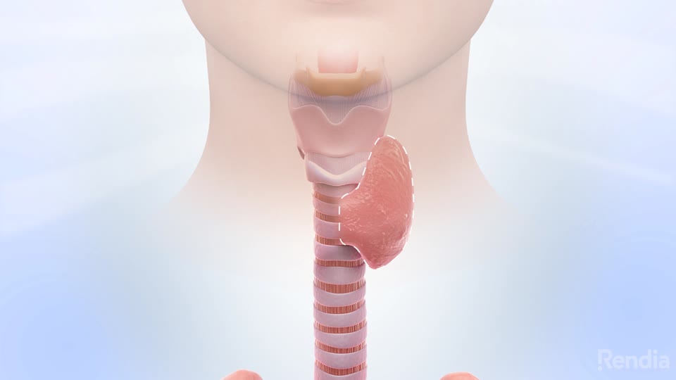 You are currently viewing Hyperthyroidism: Treatment Overview
