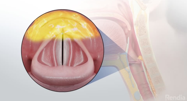 Laryngeal Reflux: Overview