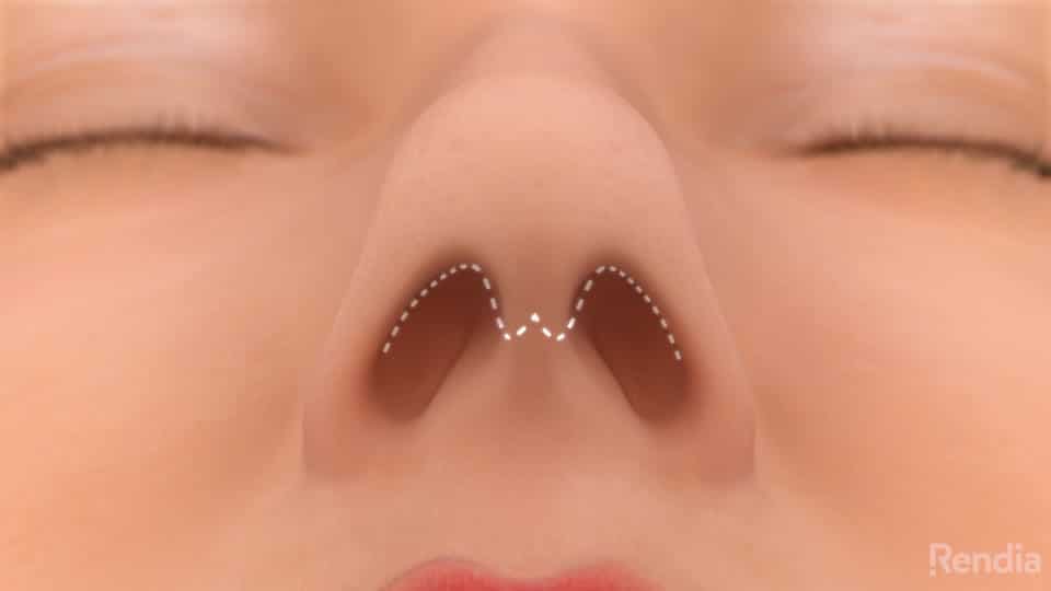 You are currently viewing Rhinoplasty: Overview