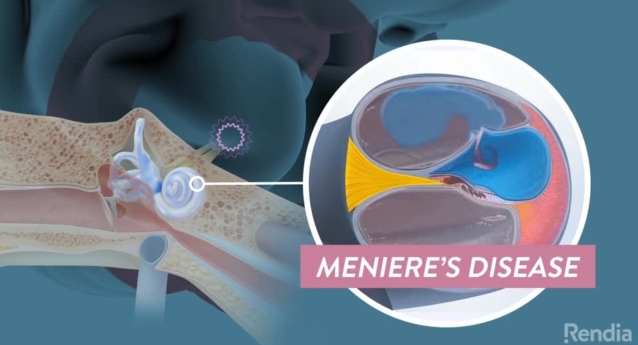 What is Meniere’s Disease?
