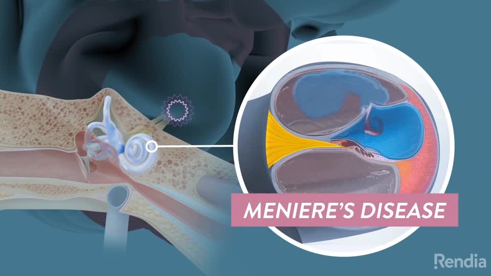 You are currently viewing What is Meniere’s Disease?