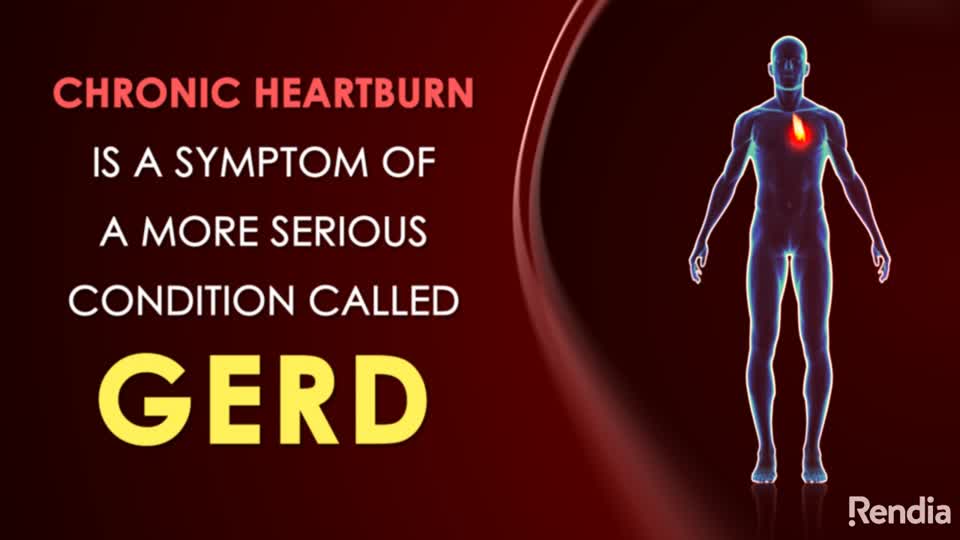 You are currently viewing Vignette: Acid Reflux – GERD