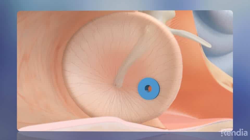 You are currently viewing Ear Tubes: Overview