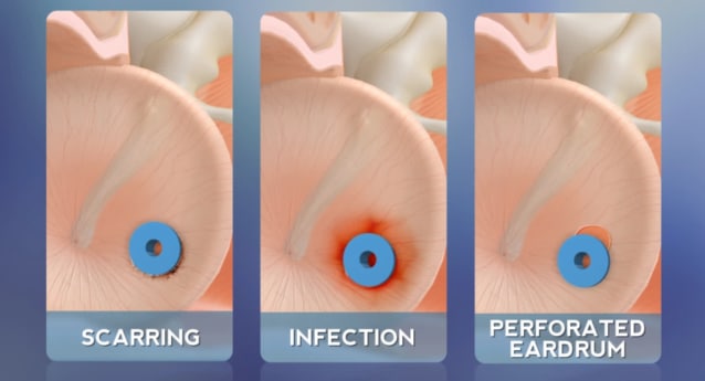 Ear Tubes: Post-Op