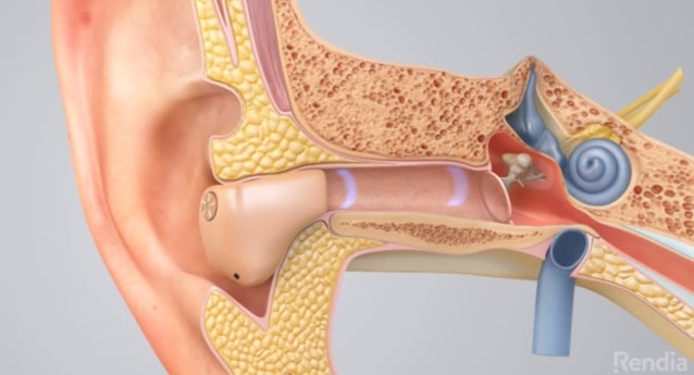 Hearing Aids: Overview