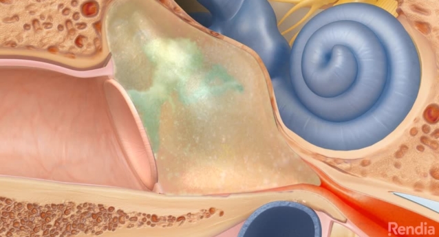 Middle Ear Infection: Overview