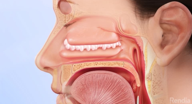 Nasal Polyps: Overview