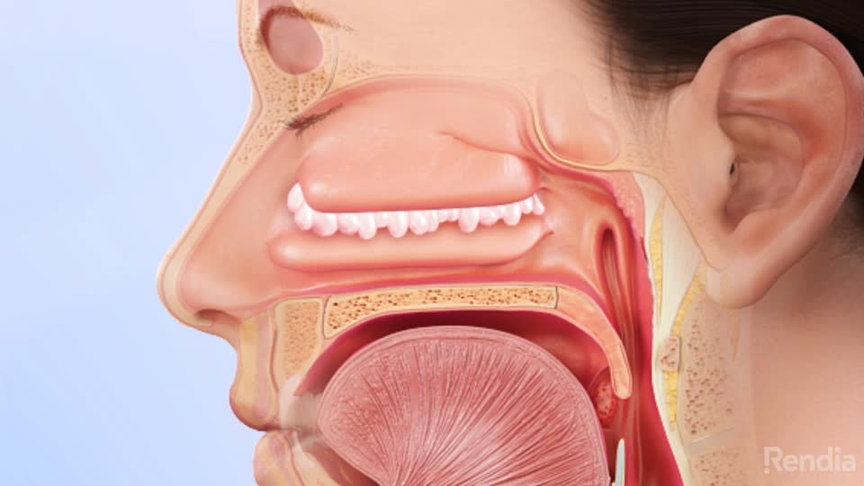 You are currently viewing Nasal Polyps: Overview