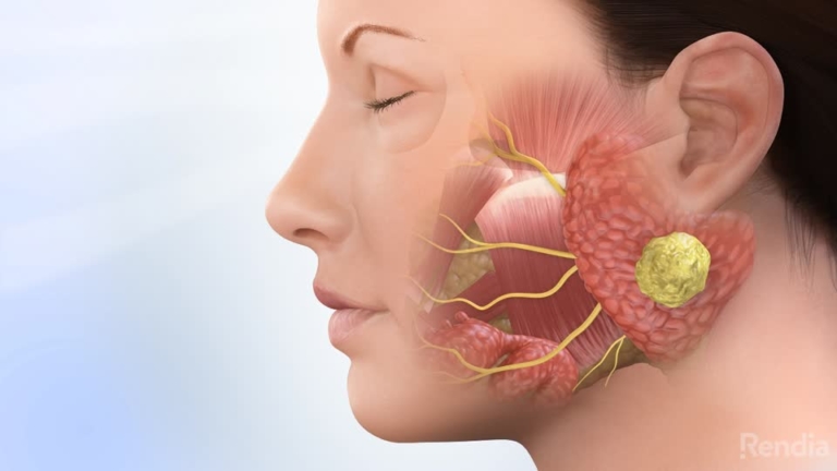 parotid-tumor-overview-entjc