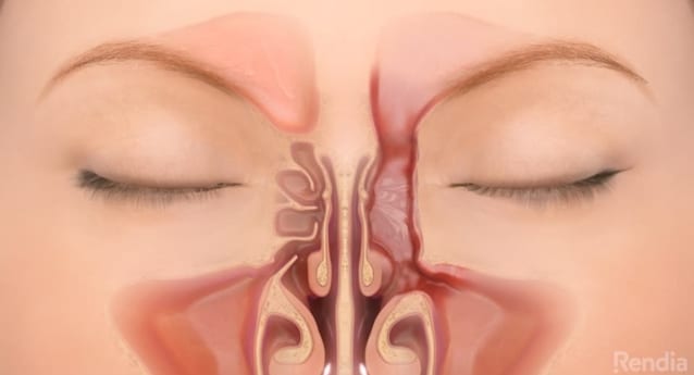 Sinus Surgery: Overview