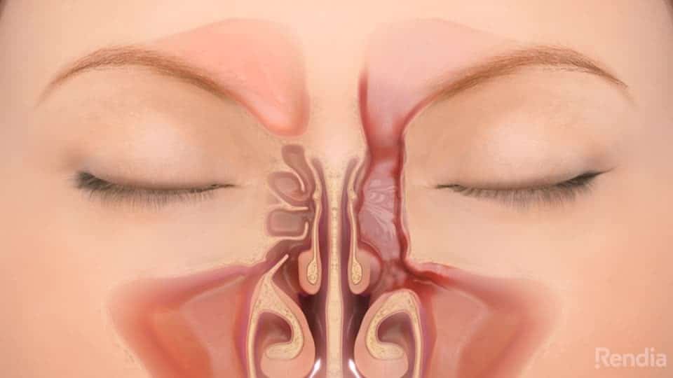 You are currently viewing Sinus Surgery: Overview