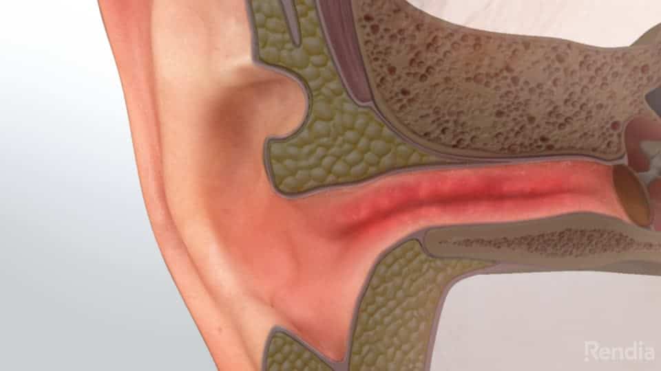 You are currently viewing Swimmer’s Ear: Overview