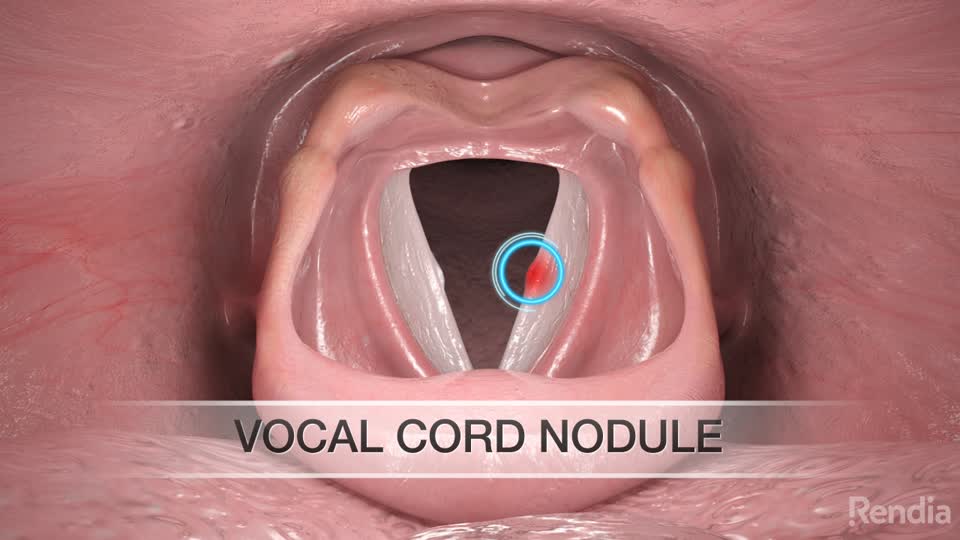 You are currently viewing Vocal Cord Nodules: Overview