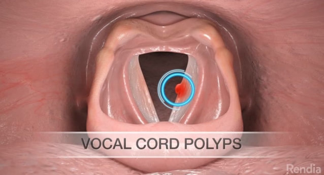Vocal Cord Polyps: Overview
