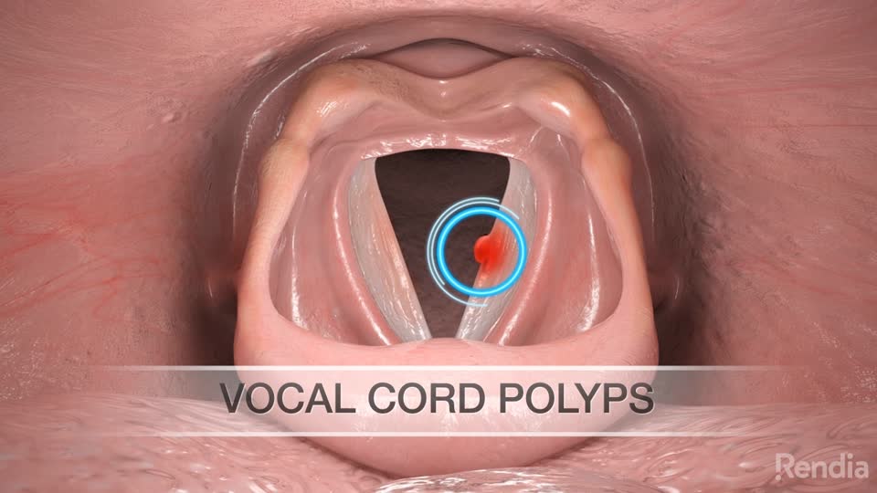 You are currently viewing Vocal Cord Polyps: Overview